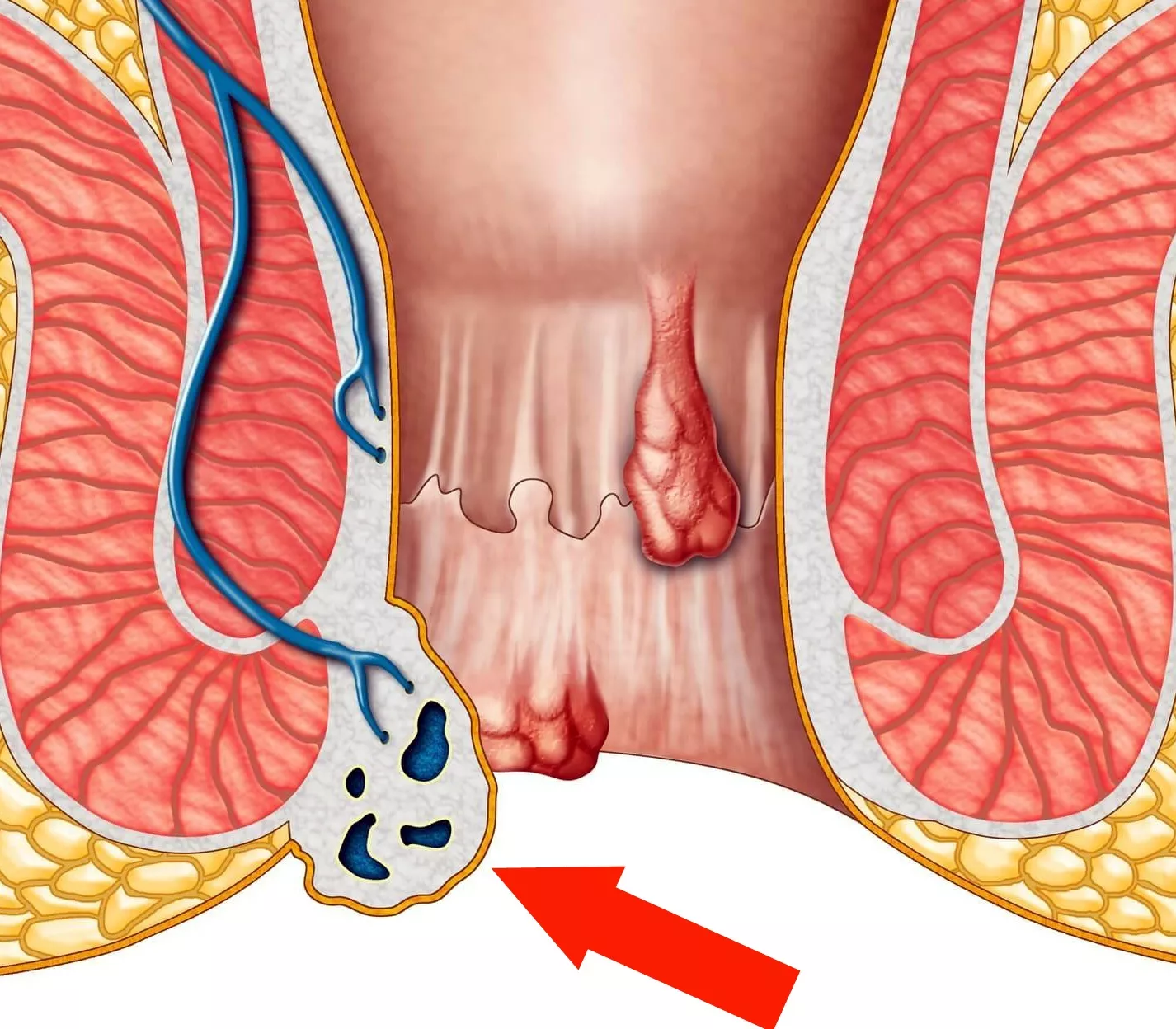 What is hemorrhoids? How Does It Heal?